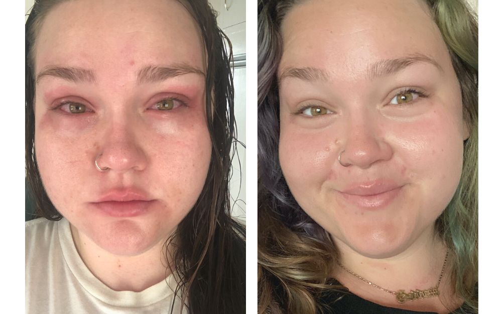 Before and After photos of Jen Bean with psoriasis after using Green Bee Botanicals cannabis eye cream and face serum