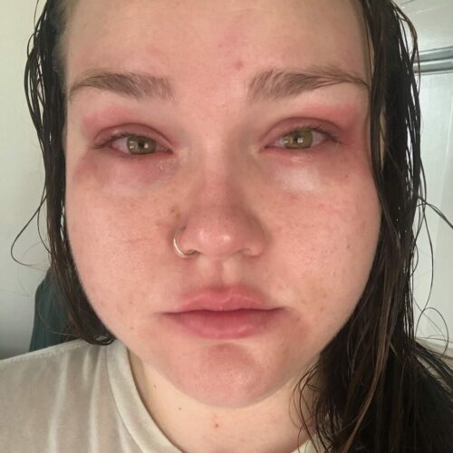 Close-up photo of Jen Bean's face, with red, itchy, painful psoriasis around both eyes